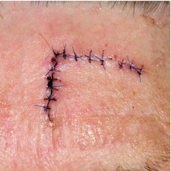 Absorbable%20Suture%20Brown%20chromic%20Catgut%20%E2%80%93%20Medgut%201-0%20(4%20Metric),%2076cm%20%7C%203/8%20Circle%20Round%20body%20Needle%20%E2%80%93%2040mm%201%20Pcs%20-%20Image%207