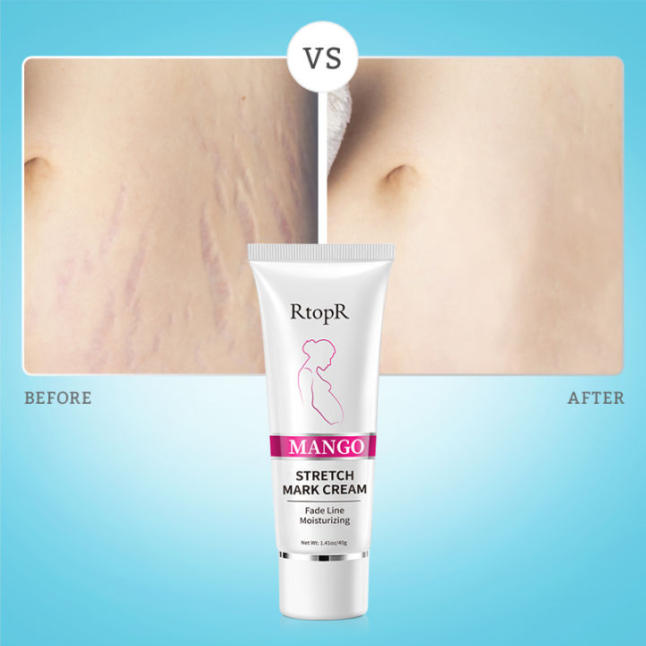 RtopR%20Mango%20Stretch%20Mark%20Cream%20Stretch%20Mark%20Repair%20Maternity%20Repair%20Cream%20Anti-Aging%20Anti-Wrinkle%20Firming%20Whitening%20Body%20Cream%2040g%20-%20Image%207