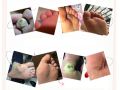 6 pcs Medical Plasters Foot Corn Removal Warts Thorn Patch Curative Patches Calluses Callosity Detox Foot Pads Toe Patches. 