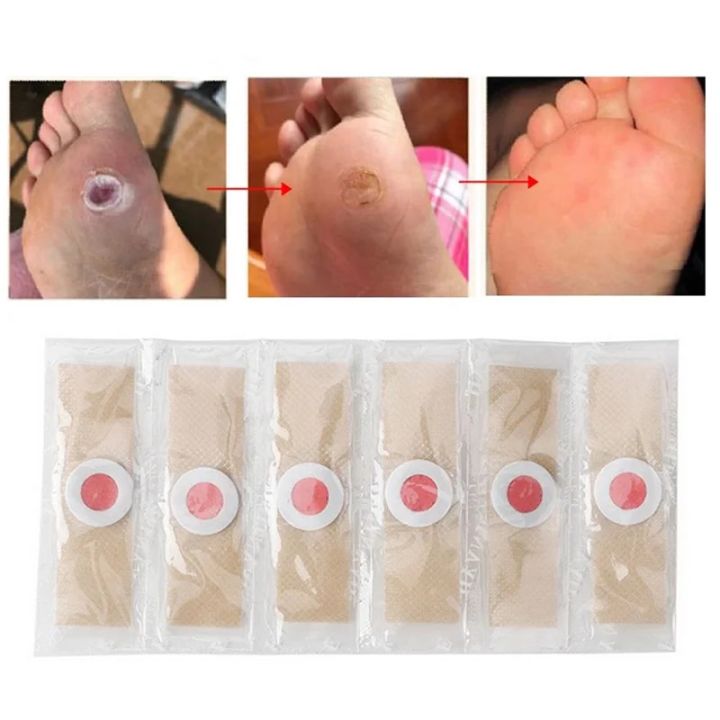 20/40Pcs Corn Patch Corn Plaster Remover Corn Toe Pads Patch Adhesive Callus Cushion Non-woven Fabric Toe Corn Callus Removal