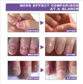 Repair Nail Fungus Treatment Serum Toe Fungal Repair Products Hand Foot Care Removal Gel Anti Infection Onychomycosis Paronychia.
