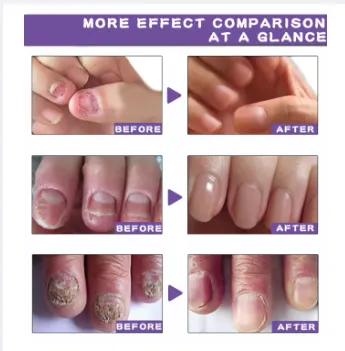 Repair%20Nail%20Fungus%20Treatment%20Serum%20Toe%20Fungal%20Repair%20Products%20Hand%20Foot%20Care%20Removal%20Gel%20Anti%20Infection%20Onychomycosis%20Paronychia%20-%20Image%202
