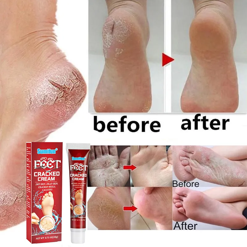 Heels Crack Foot Cream Dry Dead Skin Removal Softening
