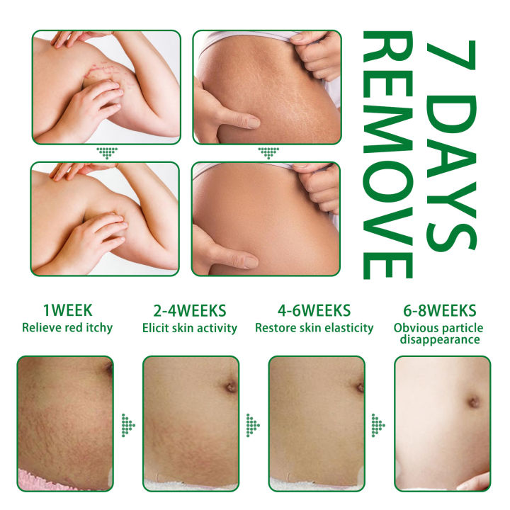 Jaysuing%20Pregnancy%20Repair%20Spray%20Fade%20Pregnant%20Women%20Pregnancy%20Fine%20Lines%20Postpartum%20Skin%20Pregnancy%20Lines%20Care%20Spray%20-%20Image%205