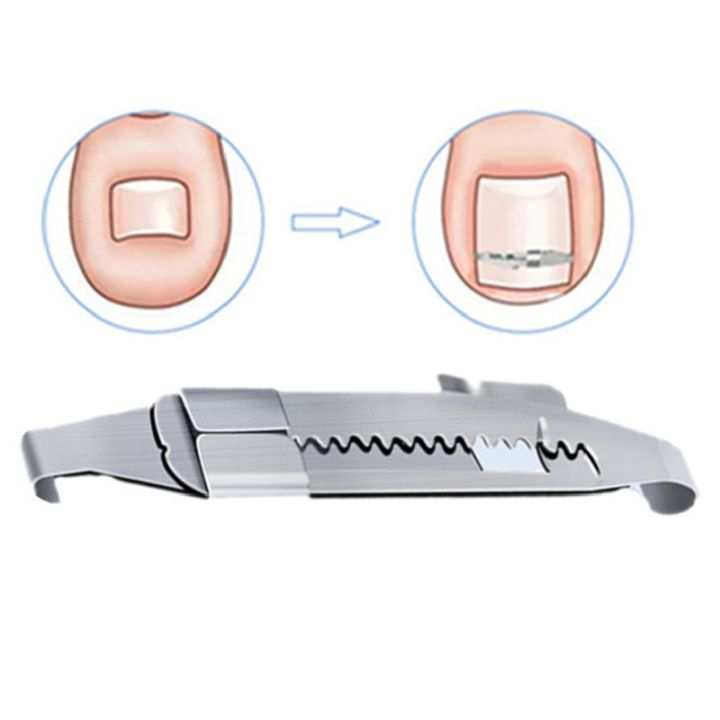 Ingrown%20toenail%20corrector%20Tools%20Pedicure%20Recover%20Embed%20Toe%20Nail%20Treatment%20professional%20Ingrown%20toenail%20correction%20Foot%20Care%20Tool%20-%20Image%205