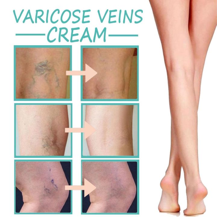 Varicocele%20Cream%20Relieving%20Limb%20Swelling,%20Soothing,%20and%20Moisturizing%20Skin%20-%20Image%202