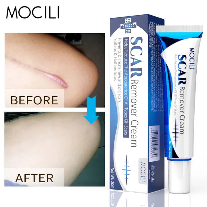 Acne%20Surgical%20Stretch%20Marks%20Removal%20Scar%20Cream%20Repair%20Smoothening%20Whitening%20Body%20Skin%20Care%20Pigmentation%20Beauty%20Cosmetics%2020g%20AOutlierA%20-%20Image%202
