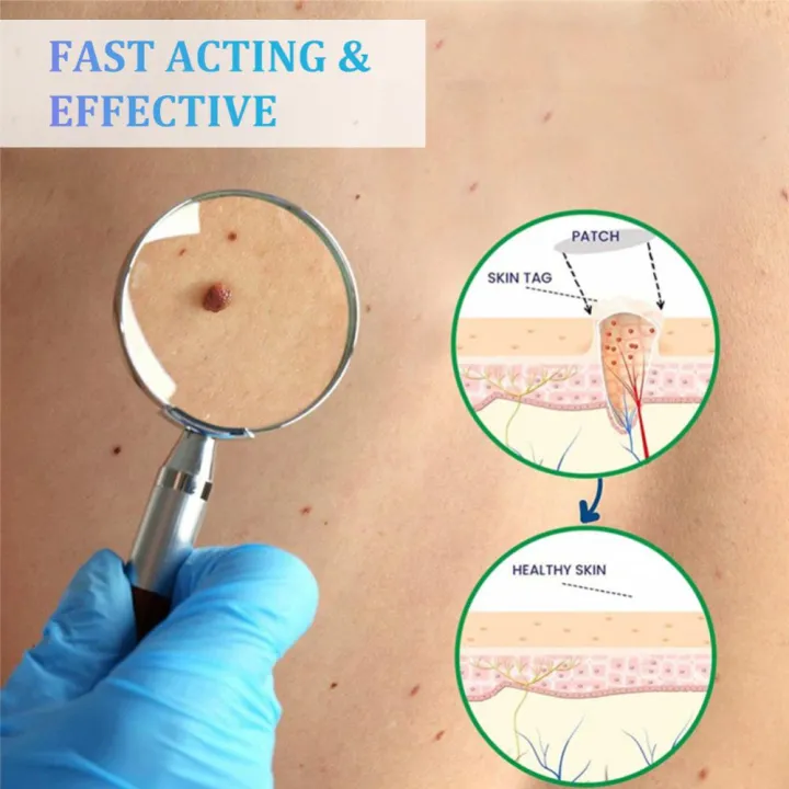2-IN-1%20Auto%20Skin%20Tag%20Removal%20Kit%20Painless%20Skin%20Label%20Mole%20Acne%20Wart%20Removal%20Pen%20Set%20with%20Cleansing%20Swabs%20Facial%20Beauty%20Care%20Tool%20-%20Image%206