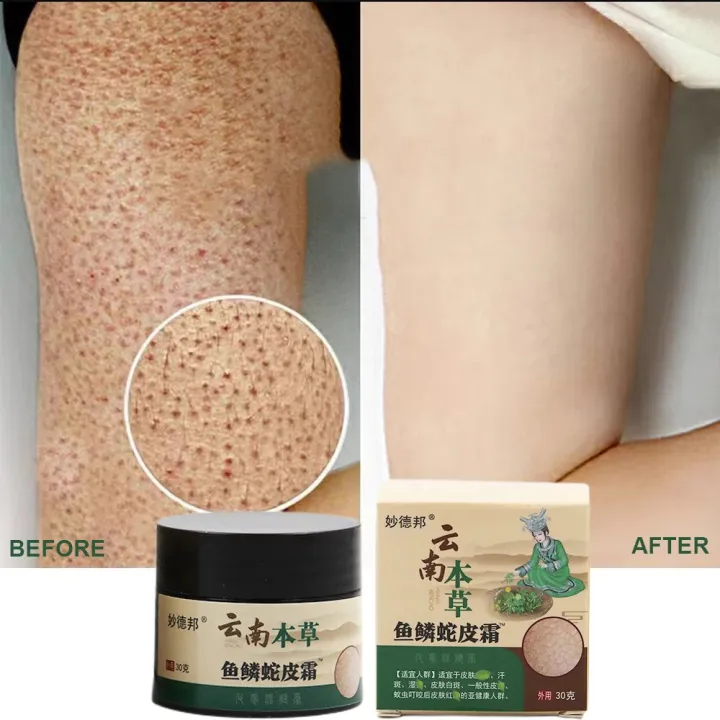 Coarse%20body%20hair,%20removal,%20cyst%20removal,%20Pila,%20good%20cream,%20keratosis,%20hairy%20chicken,%20skin%20condition,%20hole%20modification,%20dark%20spots,%20moisturizing,%20whitening,%20smooth%20skin%20care%20-%20Image%202