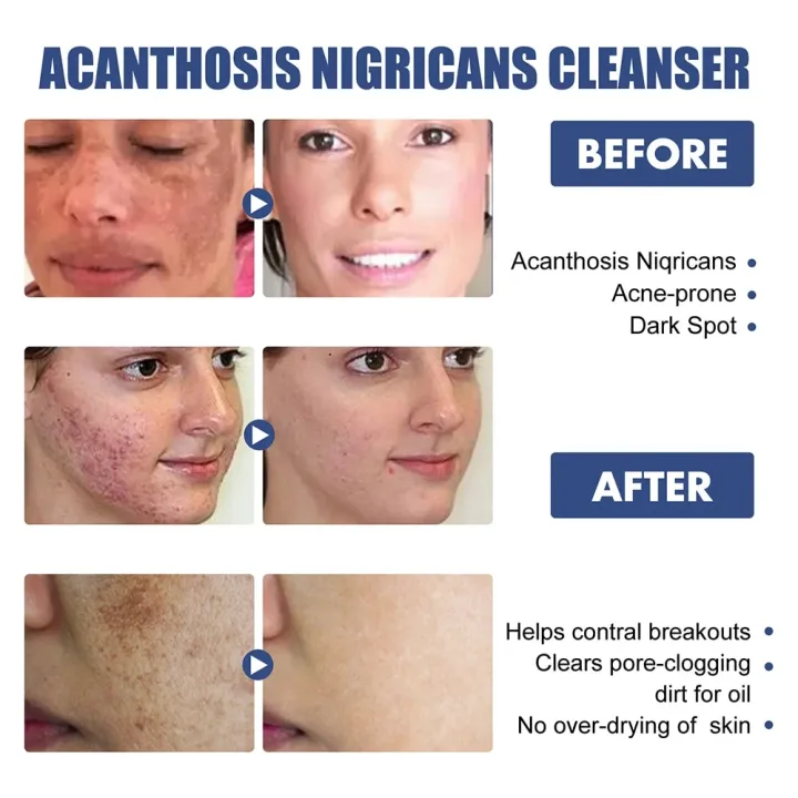 50ml%20Whitening%20Facial%20Cleanser%20Amino%20Acid%20Foam%20Scrub%20Cleansing%20Anti-Acne%20Oil%20Control%20Blackhead%20Remover%20Moisturizing%20Brightening%20-%20Image%206