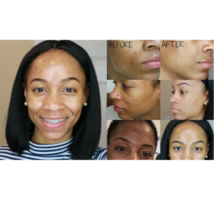 29ml%20Original%20Mario%20Badescu%20Effective%20Acne%20Facial%20Serum%20Treatment%20Drying%20Lotion%20Anti%20Acne%20Serum%20Pimple%20Blemish%20Removal%20Skin%20Care%20-%20Image%202