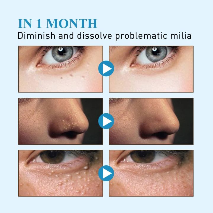 New%20144patch/Box%20Milia%20Remover%20Eye%20Cream%20Nourishing%20Moisturizing%20Repair%20Smoothing%20Eye%20Patches%20Eyes%20Pad%20-%20Image%204