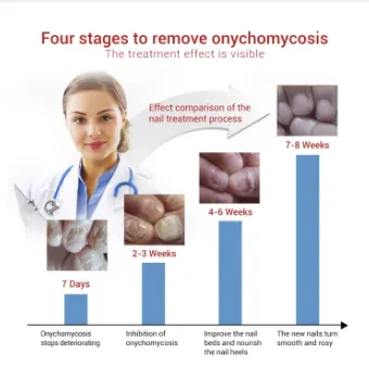 Repair%20Nail%20Fungus%20Treatment%20Serum%20Toe%20Fungal%20Repair%20Products%20Hand%20Foot%20Care%20Removal%20Gel%20Anti%20Infection%20Onychomycosis%20Paronychia%20-%20Image%204