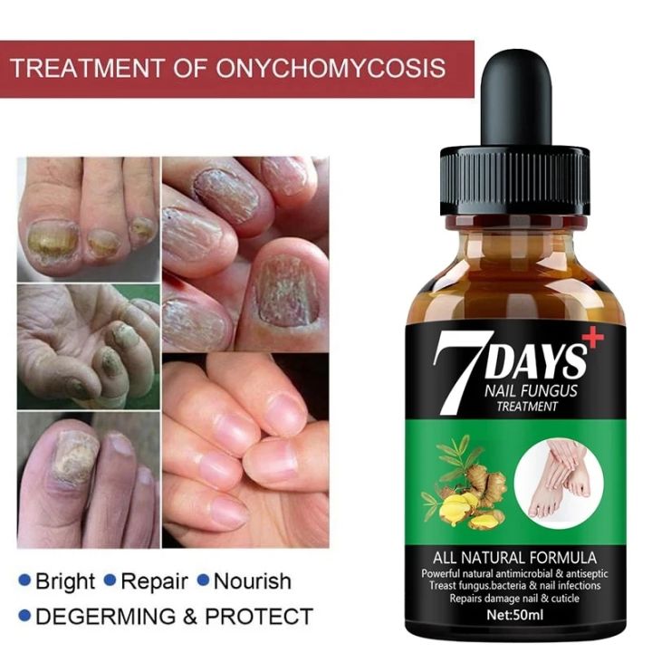 7DAYS%20Repair%20Nail%20Fungus%20Treatments%20Essence%20Foot%20Care%20Serum%20Toe%20Nails%20Fungal%20Removal%20Gel%20Anti-Infection%20Onychomycosis%20Care%20Tool%20-%20Image%203