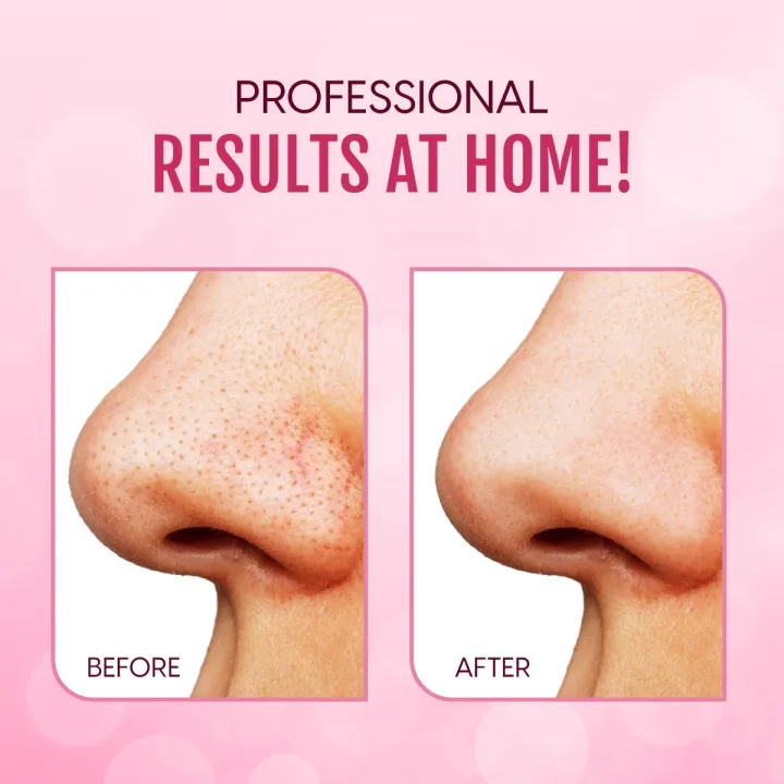 %E3%80%BD%EF%B8%8F%20Bron%20Stick%20/%20Blackhead%20Remover%20Tool%20Acne%20Pimple%20Extractor%20(Silver)%201%20pcs%20-%20Image%206