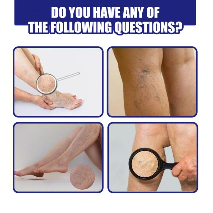 %E3%80%90Top-Rated%20Product%E3%80%91%20Varicose%20Veins%20Spray%20Spider%20Veins%20Relief%20Vasculitis%20Phlebitis%20Spider%20Pain%20Relief%20Plaster%20Care%2030ml%20-%20Image%206