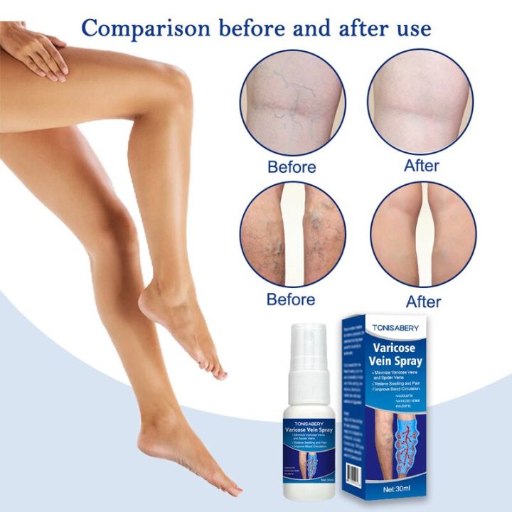Varicose%20Vein%20Treatment%20Spray%20Vasculitis%20Phlebitis%20Spider%20Relief%20Fatigue%20Leg%20Dilation%20Pain%20Herbal%20Beauty%20Body%20Skin%20Care%2030ml%20-%20Image%202