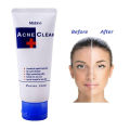 International Thailand product Skin care Mistine Acne Clear + used for male/female - 85 gm. 