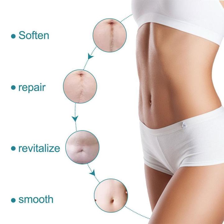 Silicone%20Scar%20Sheets%20Patch%20Painless%20Scar%20Repair%20Tape%20Roll%20Effective%20Scar%20Removal%20Strips%20For%20C-Section%20Keloid%20Surgery%20Burn%20A%20H8K5%20-%20Image%203