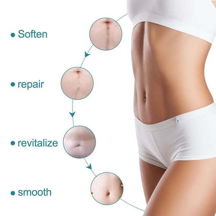 Silicone%20Scar%20Sheets%20Patch%20Painless%20Scar%20Repair%20Tape%20Roll%20Effective%20Scar%20Removal%20Strips%20For%20C-Section%20Keloid%20Surgery%20Burn%20A%20H8K5%20-%20Image%203