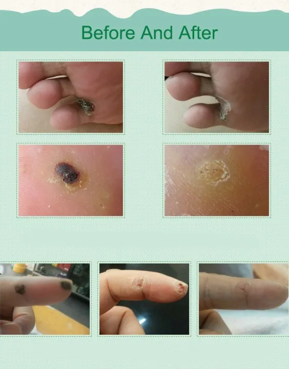 6%20pcs%20Medical%20Plasters%20Foot%20Corn%20Removal%20Warts%20Thorn%20Patch%20Curative%20Patches%20Calluses%20Callosity%20Detox%20Foot%20Pads%20Toe%20Patches%20-%20Image%205