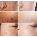 Whitening Freckle Cream Effective Remove Melasma Cream Remove Dark Spots Melanin Moisturize Brighten Smooth Face Skin Care.