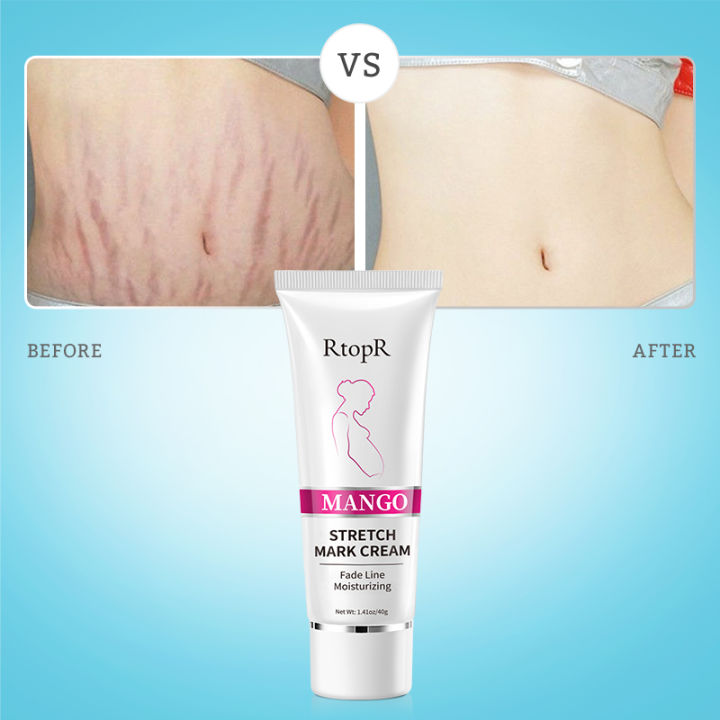 RtopR%20Mango%20Stretch%20Mark%20Cream%20Stretch%20Mark%20Repair%20Maternity%20Repair%20Cream%20Anti-Aging%20Anti-Wrinkle%20Firming%20Whitening%20Body%20Cream%2040g%20-%20Image%204