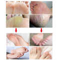 Callus Remover Professional Foot Pedicure Peeling Dead Skin Cutter Knife Calluses Tool.