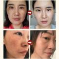 BataBata Whitening Freckles Cream Effective Remove Melasma Dark Spots Fade Pigmentation Moisturize Smooth Brighten Face Skin Care Product. 