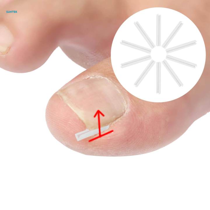 10Pieces%20Ingrown%20Toenail%20Corrector%20Strips,%20Toenail%20Correction%20Patches%20Foot%20Care%20-%20Image%206