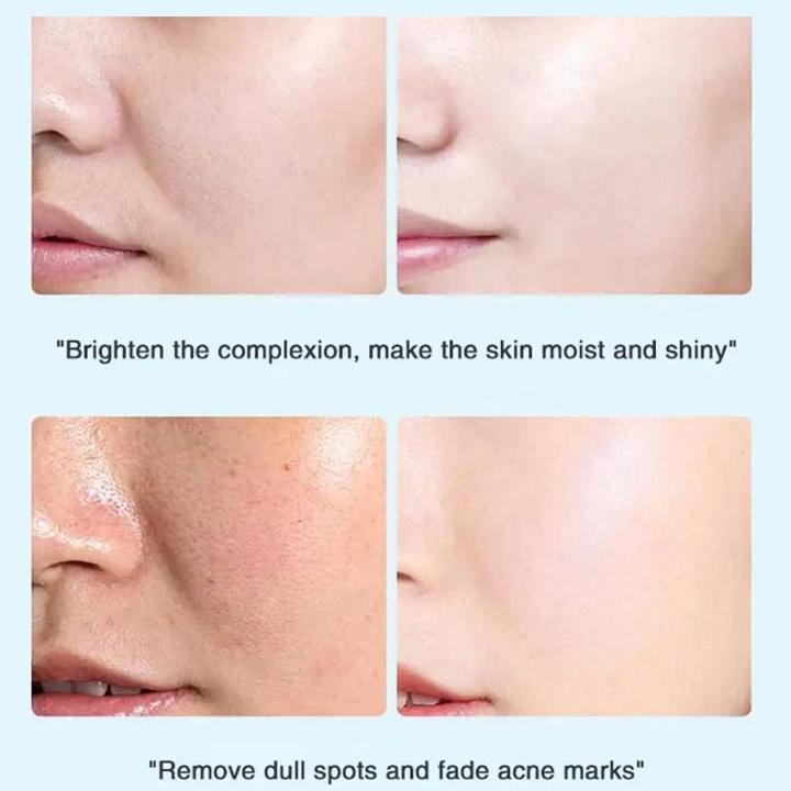 Whitening%20Cream%20For%20Face%20Spots%20Remove%20Dark%20Spot%20Melasma%20Anti-Pigmentation%20Improve%20Dullness%20Brighten%20Face%20Skin%20Care%20Cream%20-%20Image%204