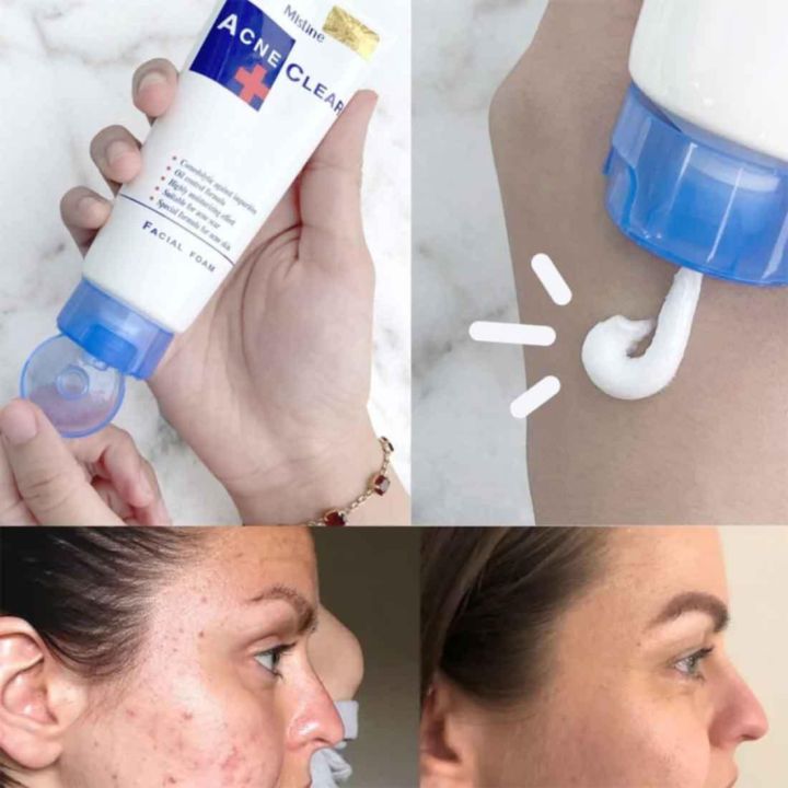 MISTINE ACNE CLEAR FACIAL FOAM 85G. Face Wash (Made In Thailand)