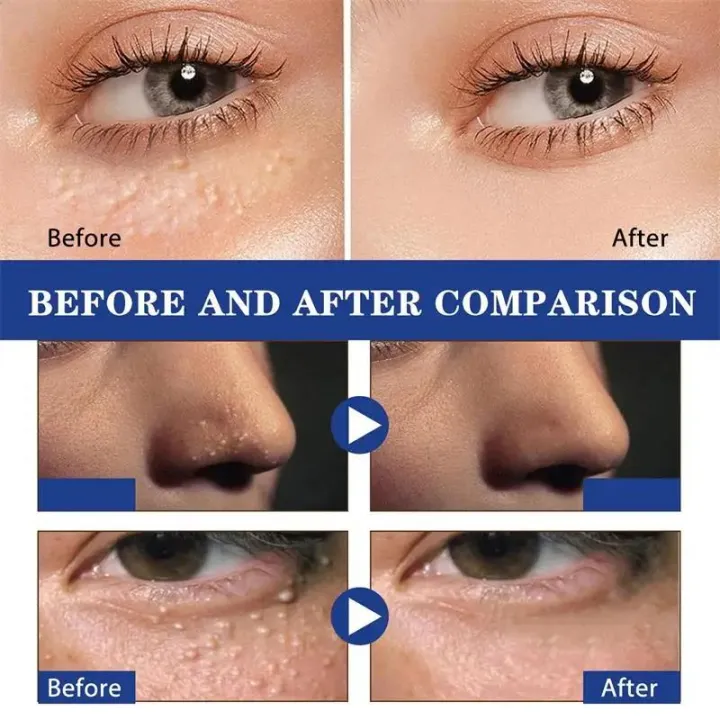 Fat%20Granules%20Removal%20Eye%20Serum%20Eye%20Milia%20Repair%20Treatment%20Products%20Wrinkle%20Lifting%20Moisturizing%20Anti-Puffiness%20Korean%20Skin%20Care%20-%20Image%202