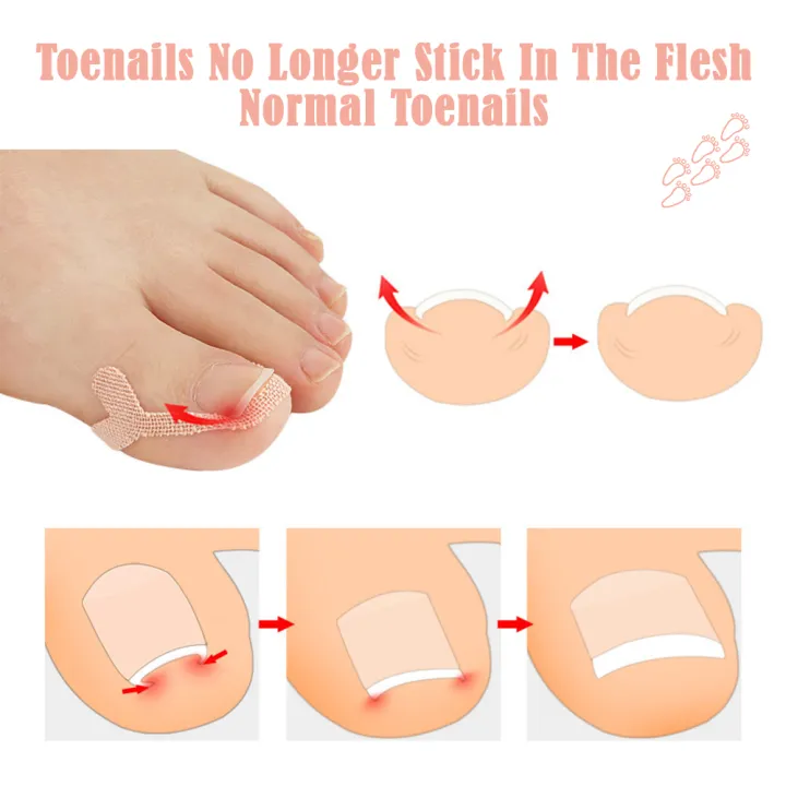 8%20Pack%20Ingrown%20Toenail%20Corrector%20Sticker%20Paronychia%20Treatment%20Fixer%20Restoration%20Pedicure%20Elastic%20Sticker%20Foot%20Toe%20Nail%20Care%20Tool%20-%20Image%203