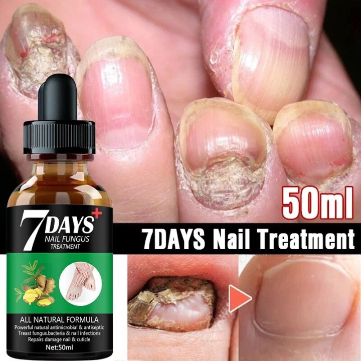7DAYS%20Repair%20Nail%20Fungus%20Treatments%20Essence%20Foot%20Care%20Serum%20Toe%20Nails%20Fungal%20Removal%20Gel%20Anti-Infection%20Onychomycosis%20Care%20Tool%20-%20Image%205