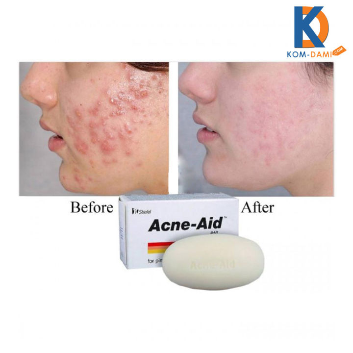 Stiefel%20Acne-Aid%20Bar%20Pimple%20Prone%20&%20Oily%20Skin%20Acne%20Aid%20Soap%20100g%20-%20Image%204