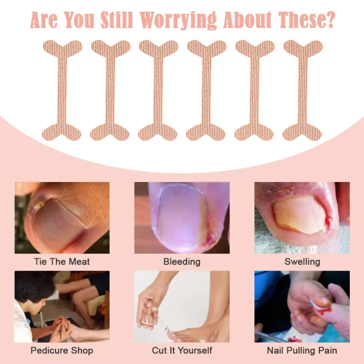 8%20Pack%20Ingrown%20Toenail%20Corrector%20Sticker%20Paronychia%20Treatment%20Fixer%20Restoration%20Pedicure%20Elastic%20Sticker%20Foot%20Toe%20Nail%20Care%20Tool%20-%20Image%202