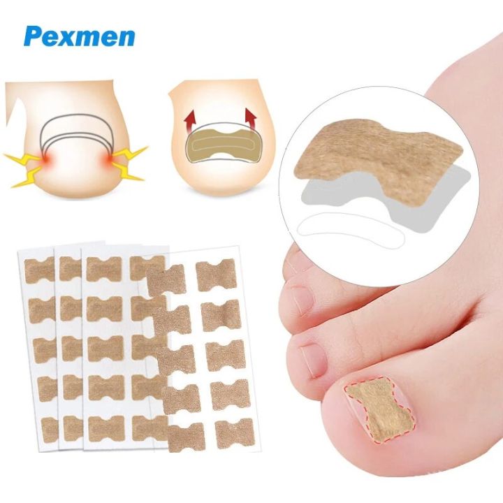 Pexmen 10/20/50/100Pcs Ingrown Toenail Correction Stickers Toenail Corrector Patch Keep Nails Healthy Relieve Pain