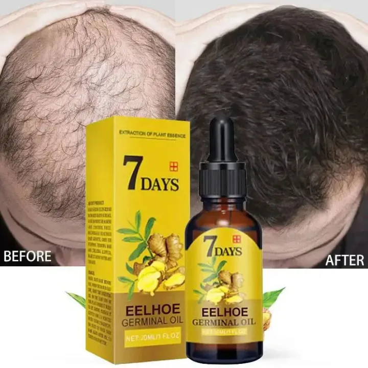 5pcs%207%20Days%20Fast%20Ginger%20Hair%20Growth%20Serum%20Anti%20Hair%20Loss%20Fast%20Growing%20Hair%20Care%20Essential%20Oil%20Repair%20Damaged%20For%20Women%20Men%20200ML%20BruberryBeE%20-%20Image%203