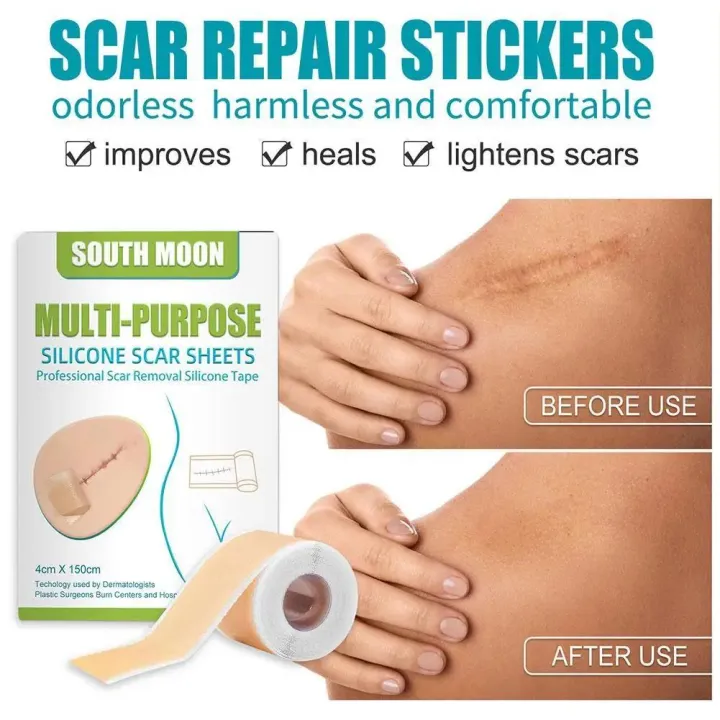 1Roll%20Scar%20Treatment%20Silicone%20Gel%20Sheet%20Efficient%20Surgery%20Scar%20Removal%20Therapy%20Patch%20For%20Acne%20Trauma%20Burn%20Scar%20Skin%20Repair%20-%20Image%205