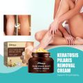 Keratosis Pilaris Removal Cream Chicken Skin Folliculities Treatment Repair Whitening Moisturizing Smooth Body Lotion. 