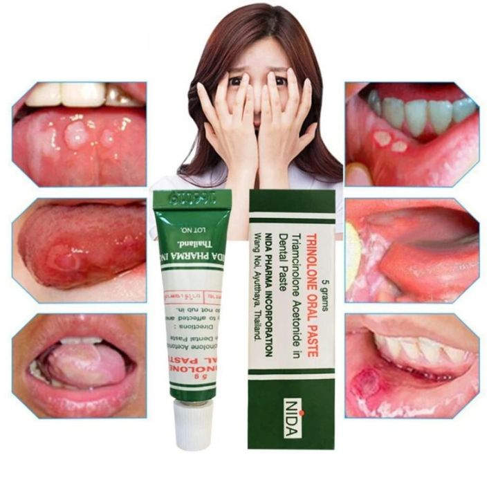 Thailand Herb Oral ulcers Cream oral inflammation toothache tongue Pain Ointment Dental care Treatment Cream Plaster
