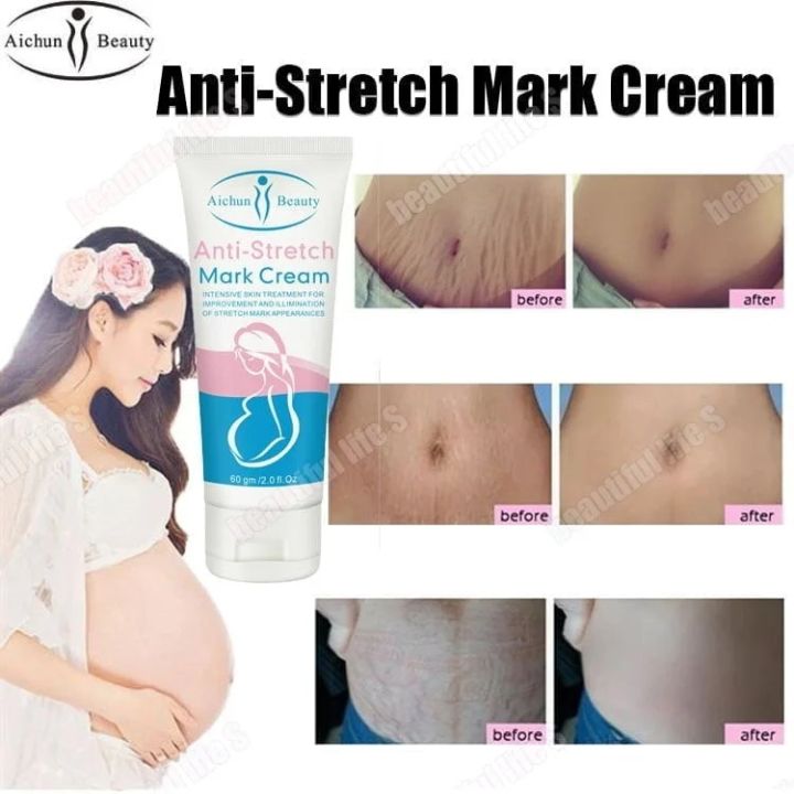 Aichun%20Beauty%20Anti-Stretch%20Marks%20Cream%20%7C%20Stretch%20Marks%20Removal%20Cream%2060g%20-%20Image%206
