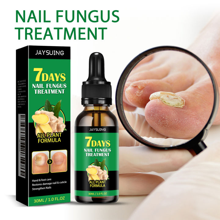Jaysuing Ginger Nail Care Nail Treatment, Nail fungus care, hand and foot nail care, soft nail brightening nail moisturizer
