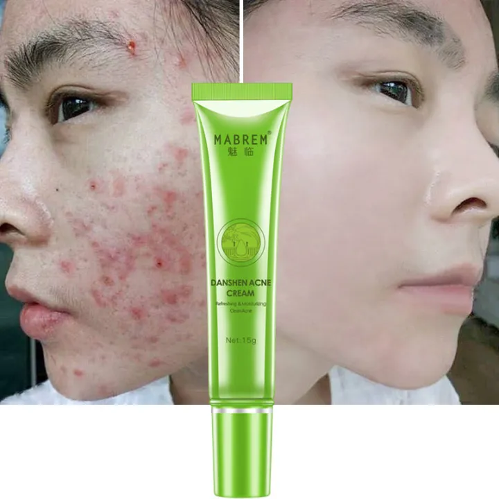Danshen%20Acne%20Cream%20Acne%20Removal%20Fades%20Acne%20Marks%20Repair%20Damaged%20Skin%20Gentle%20Non-Irritant%20Skin%20Rejuvenating%20Nourishing%20Skin%20Care%20-%20Image%203