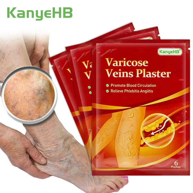 6Pcs%20Leg%20Patches%20For%20Varicose%20Veins%20Chinese%20Herbal%20Medicine%20Varicosity%20Angiitis%20Removal%20Phlebitis%20Spider%20Leg%20Veins%20Pain%20Plaster%20-%20Image%202