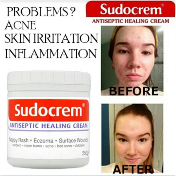 Sudocrem%20Antiseptic%20Healing%20Cream%20125g%20-%20Image%205