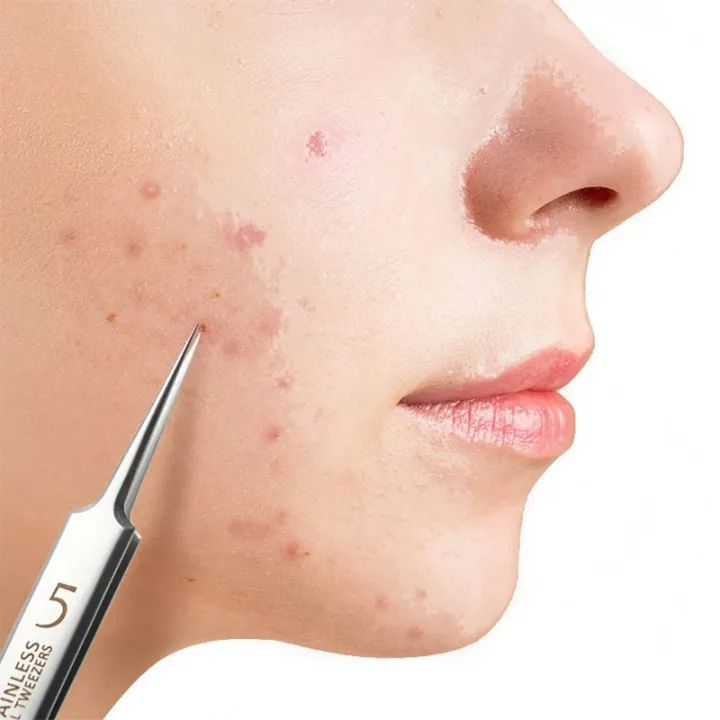 Blackhead%20Acne%20Pimple%20Remover%20Tool%20Facial%20Skin%20Care%20Products%20Kit%20Pinzas%20Para%20Espinillas%20Black%20Head%20Removal%20Tweezers%20Face%20Cleaner%20-%20Image%202