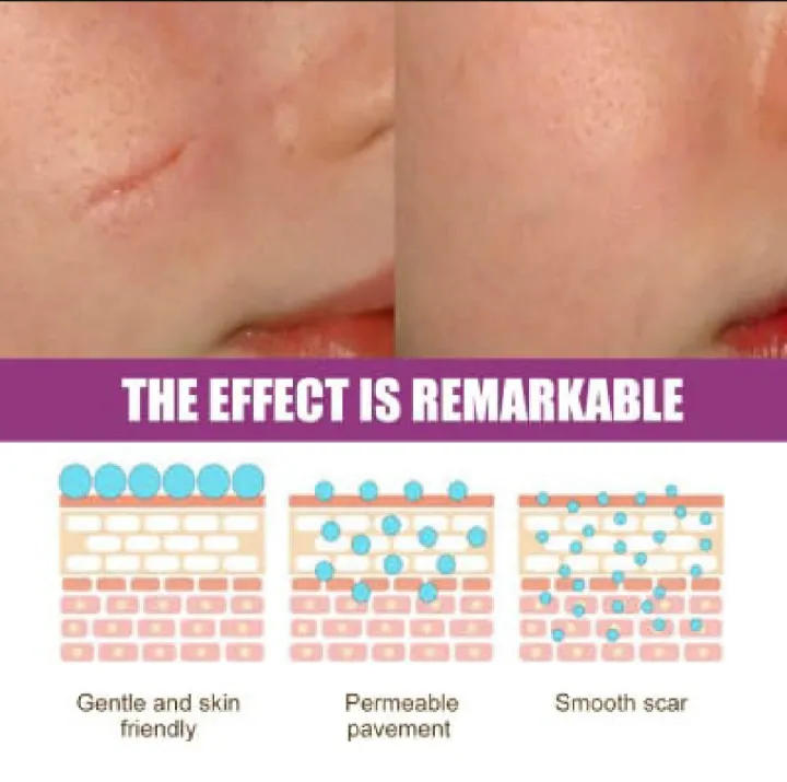 Scar%20Removal%20Cream%20Repairing%20Damaged%20Skin%20Reducing%20Scars%20And%20Smoothing%20The%20Skin%2050g,%20%E0%A6%95%E0%A6%BE%E0%A6%9F%E0%A6%BE%20%E0%A6%93%20%E0%A6%AA%E0%A7%81%E0%A7%9C%E0%A7%87%20%E0%A6%AF%E0%A6%BE%E0%A6%93%E0%A7%9F%E0%A6%BE%E0%A6%B0%20%E0%A6%A6%E0%A6%BE%E0%A6%97%20%E0%A6%B8%E0%A7%8D%E0%A6%95%E0%A6%BF%E0%A6%A8%20%E0%A6%A5%E0%A7%87%E0%A6%95%E0%A7%87%20%E0%A6%AE%E0%A7%81%E0%A6%9B%E0%A7%87%20%E0%A6%AB%E0%A7%87%E0%A6%B2%E0%A7%81%E0%A6%A8%E0%A5%A4%20%E0%A6%AE%E0%A7%81%E0%A6%96%E0%A6%AE%E0%A6%A8%E0%A7%8D%E0%A6%A1%E0%A6%B2,%20%E0%A6%B9%E0%A6%BE%E0%A6%A4,%20%E0%A6%AA%E0%A6%BE,%20%E0%A6%AC%E0%A6%A1%E0%A6%BF%20%E0%A6%85%E0%A6%A5%E0%A6%AC%E0%A6%BE%20%E0%A6%B8%E0%A7%8D%E0%A6%95%E0%A6%BF%E0%A6%A8%E0%A7%87%E0%A6%B0%20%E0%A6%AF%E0%A7%87%E0%A6%95%E0%A7%8B%E0%A6%A8%E0%A7%8B%20%E0%A6%AF%E0%A6%BE%E0%A7%9F%E0%A6%97%E0%A6%BE%E0%A6%A4%E0%A7%87%20%E0%A6%AC%E0%A7%8D%E0%A6%AF%E0%A6%AC%E0%A6%B9%E0%A6%BE%E0%A6%B0%20%E0%A6%95%E0%A6%B0%E0%A6%A4%E0%A7%87%20%E0%A6%AA%E0%A6%BE%E0%A6%B0%E0%A6%AC%E0%A7%87%E0%A6%A8,%20#lazbinstore%20-%20Image%207