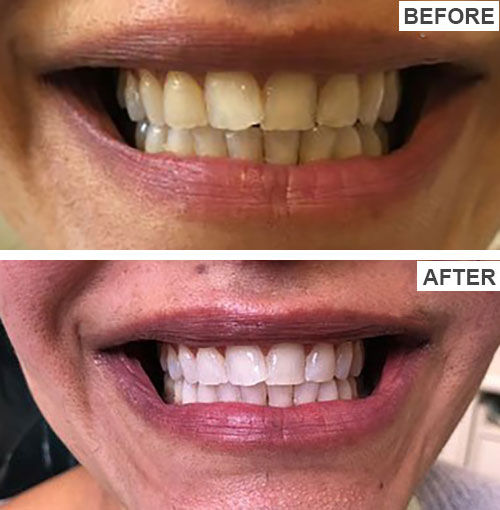 ELHOE%20Teeth%20Whitening%20Drops%20%E2%80%93%20100%25%20Natural%20Herbal%20Formula%20%E2%80%93%20Instantly%20Whitens%20Yellow%20Teeth,%20Removes%20Stains,%20Fights%20Bad%20Breath%20&%20Plaque%20%E2%80%93%20Strengthens%20Gums%20&%20Enamel%20%E2%80%93%20Safe%20for%20Sensitive%20Teeth%20%E2%80%93%20Fluoride-Free%20Liquid%20Oral%20Care%20for%20Men%20&%20Women%20-%20Image%208